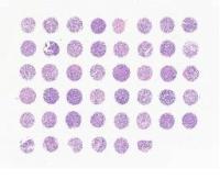 中科光华胃癌及癌旁胃组织芯片，附WHO Grade，TNM及Stage