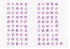 中科光华StageIIIA-IV期肝癌组织芯片，含TNM、Stage及Grade