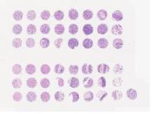 中科光华多器官肿瘤与其匹配边缘组织组合芯片+标记点