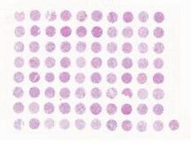 中科光华肾肿瘤及匹配癌旁，及正常肾组织组合芯片，附WHO Grade, TNM及Stage