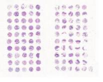 中科光华结肠癌及匹配癌旁组织芯片，癌和癌旁分开显示，附WHO Grade，TNM及Stage