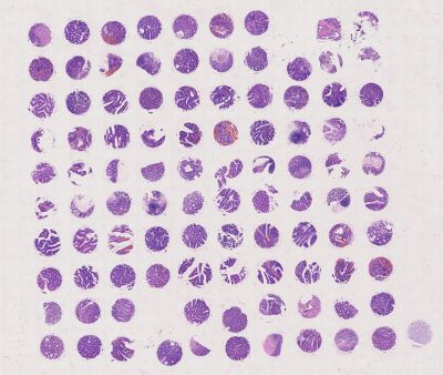 中科光华结肠多种腺瘤组织组合芯片