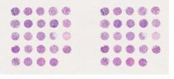 中科光华乳腺癌组织芯片，附WHO Grade，TNM及Stage