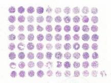 中科光华肺小细胞癌及正常肺组织芯片，资料信息包含TNM及Stage（AJCC8#）