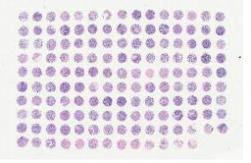 中科光华乳腺癌组织芯片，附TNM、临床分期和病理分级